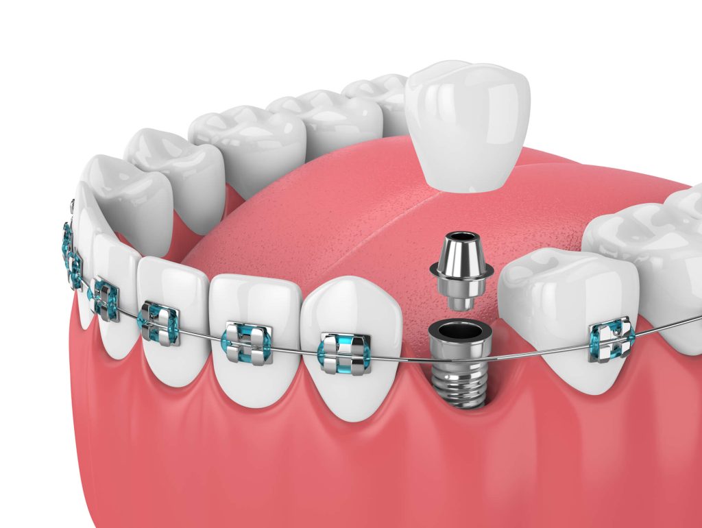 3D image of dental implants in Greenville SC